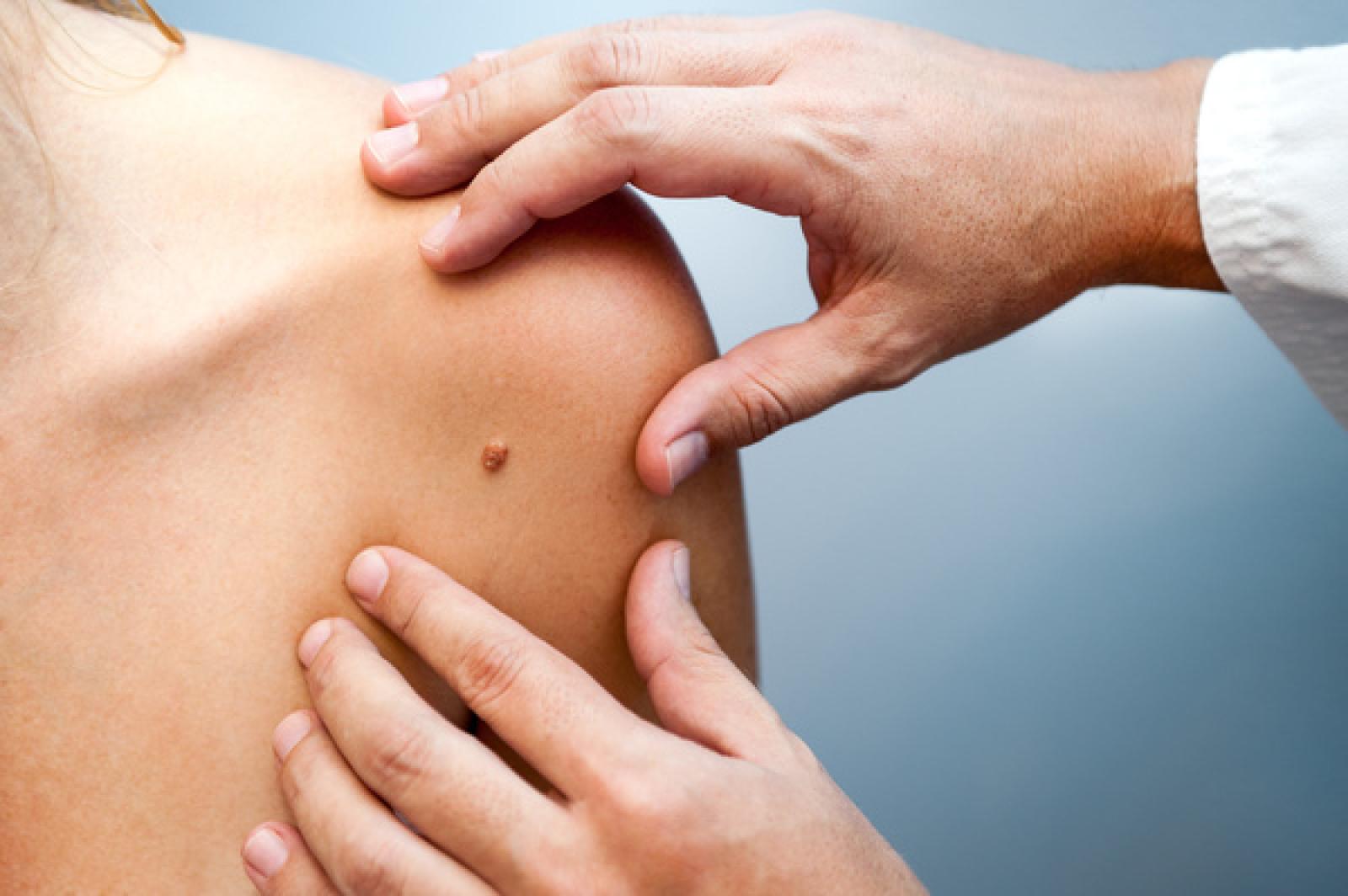Prevenzione del melanoma: screening gratuiti con Lilt