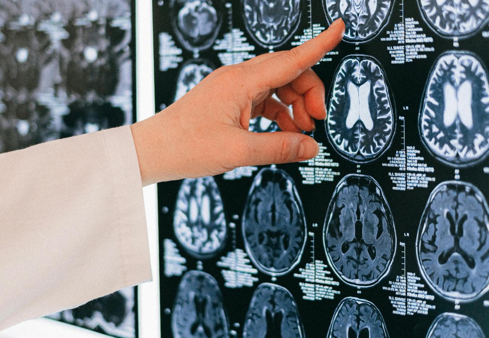 Venezia, attivata all&rsquo;Ospedale Civile la nuova Area Sub Intensiva Internistica-Stroke Unit