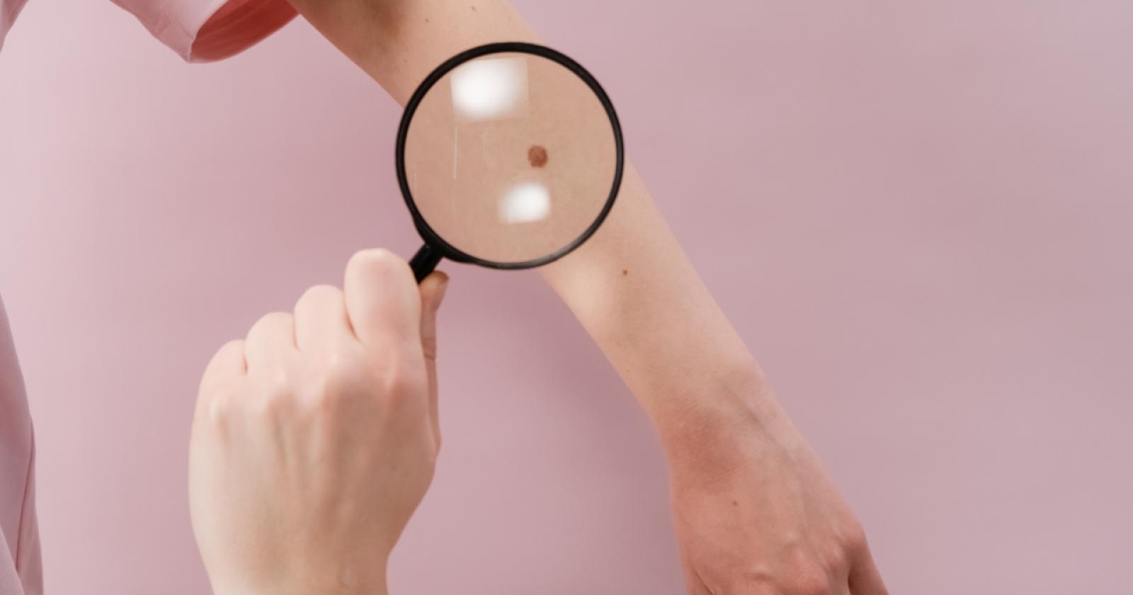 Controlli della pelle contro il melanoma