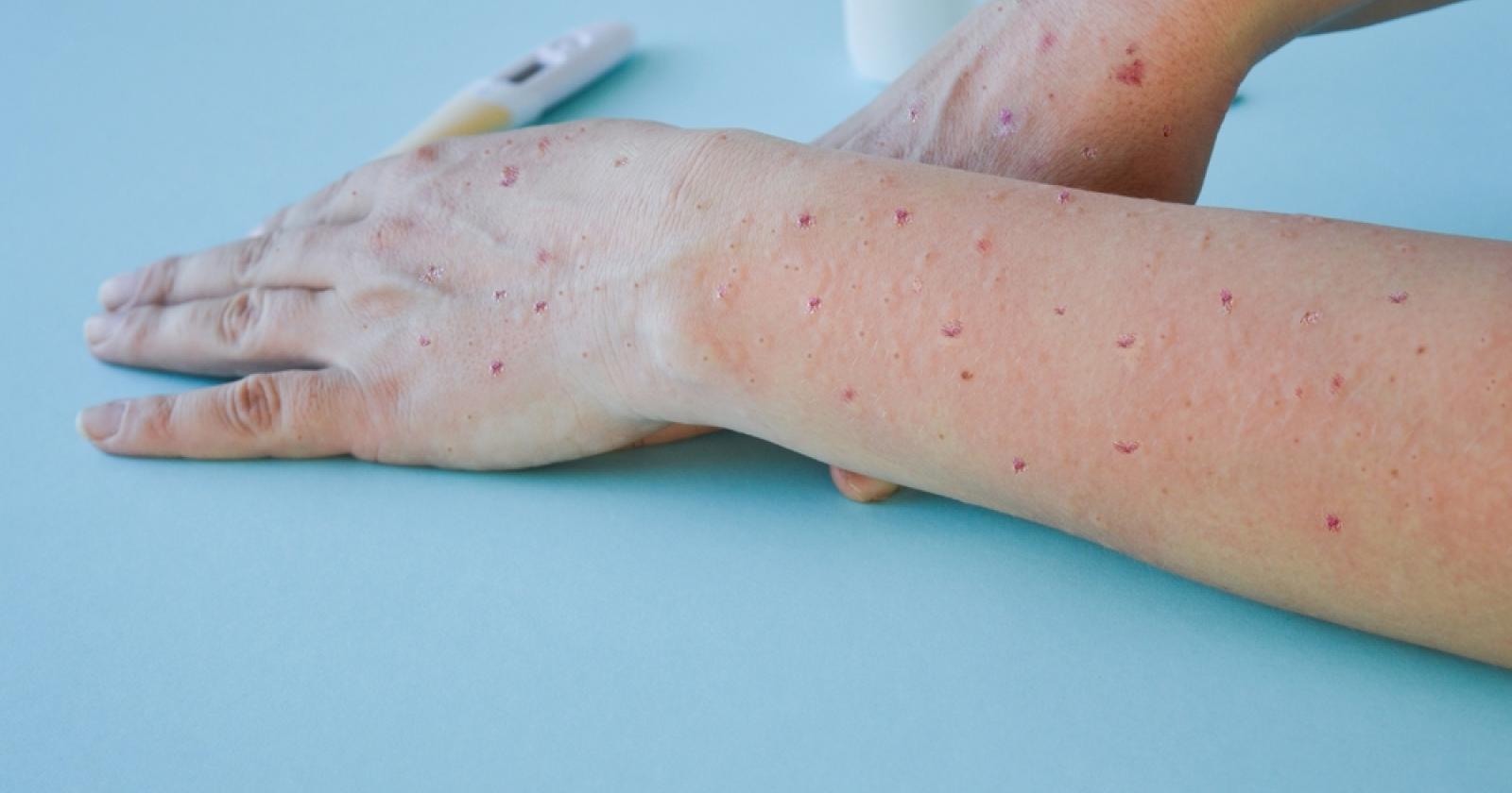 Vaiolo delle scimmie, i casi salgono a 55