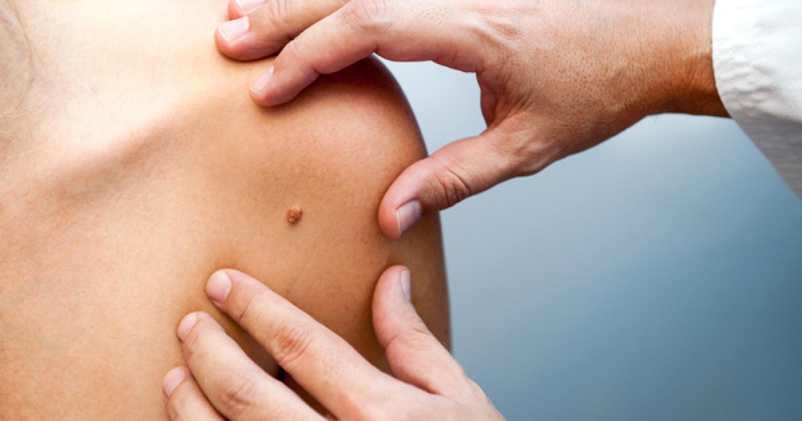 Prevenzione del melanoma: screening gratuiti con Lilt