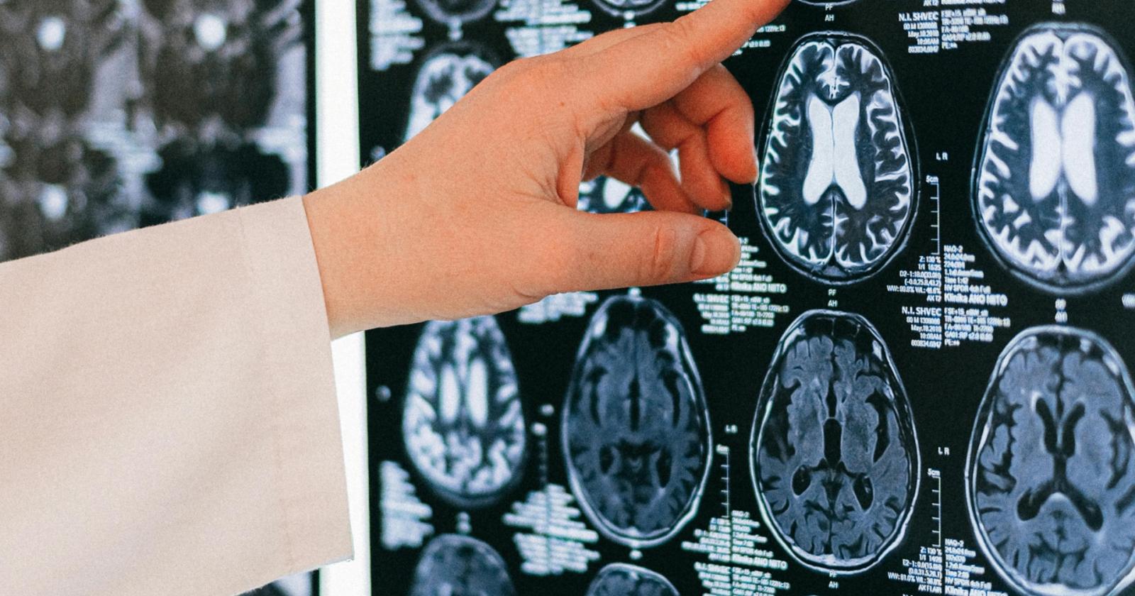 Venezia, attivata all’Ospedale Civile la nuova Area Sub Intensiva Internistica-Stroke Unit