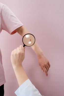 Controlli della pelle contro il melanoma